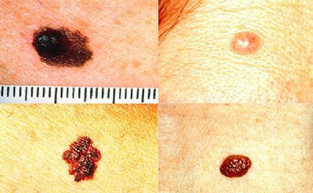 “Nutrizione e salute”, al via a Santa Maria di Licodia la campagna contro il melanoma