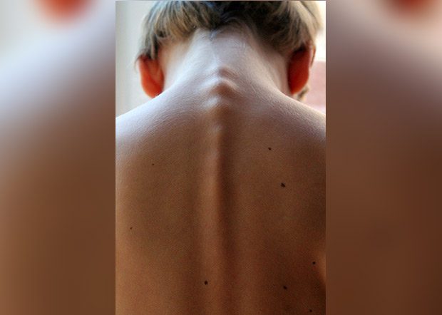 Santa Maria di Licodia, protocollo d’intesa tra Rotary e Comune su prevenzione del melanoma